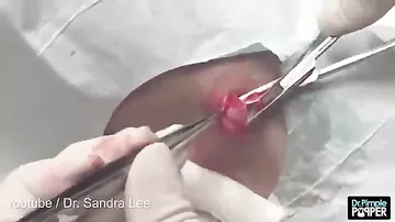 Gruesome moment a huge lump is removed from foot