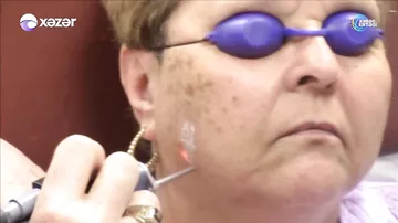 Günəş ləkələrindən necə qorunaq? – Dermatoloq AÇIQLAYIR