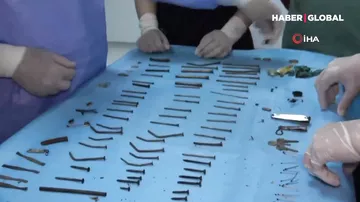 Türkiyədə gənc qızın mədəsindən 158 metal əşya çıxdı