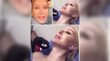 60 yaşlı sənətçi növbəti dəfə estetik əməliyyat keçirdi
