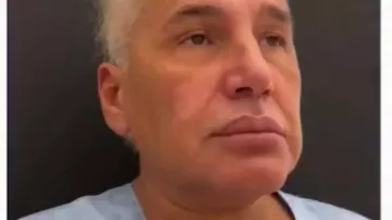 Samir Bağırov plastik əməliyyatdan əvvəl