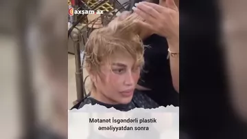 Mətanət İsgəndərli plastik əməliyyatdan sonra 5
