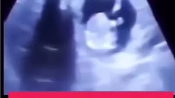 Azərbaycanda NADİR HADİSƏ: uşaq ananın bətnində yox, qaraciyərindədir