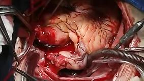 Одна из сложнейших хирургических операций - Пересадка сердца