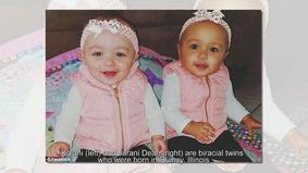 В США родились близнецы с разным цветом кожи