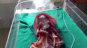 Ребенок с четырьмя руками и четырьмя ногами родился в Индии