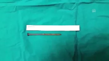 91 yaşlı kişinin ağciyərindən çıxan görənləri DƏHŞƏTƏ GƏTİRİR